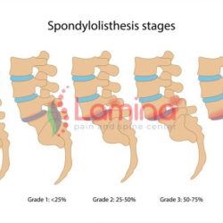 Spondylolisthesis january